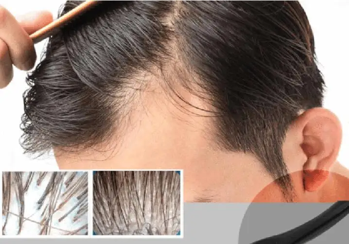 Hair Regrowth Micro-needling Roller Beard Growth Product Anti Hair Loss