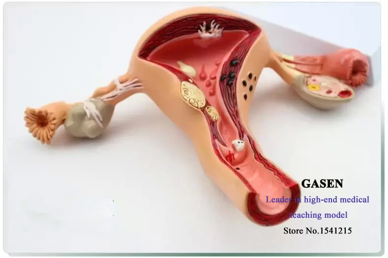 The Body Of The Uterus Ovary Vagina Disease Model -2395