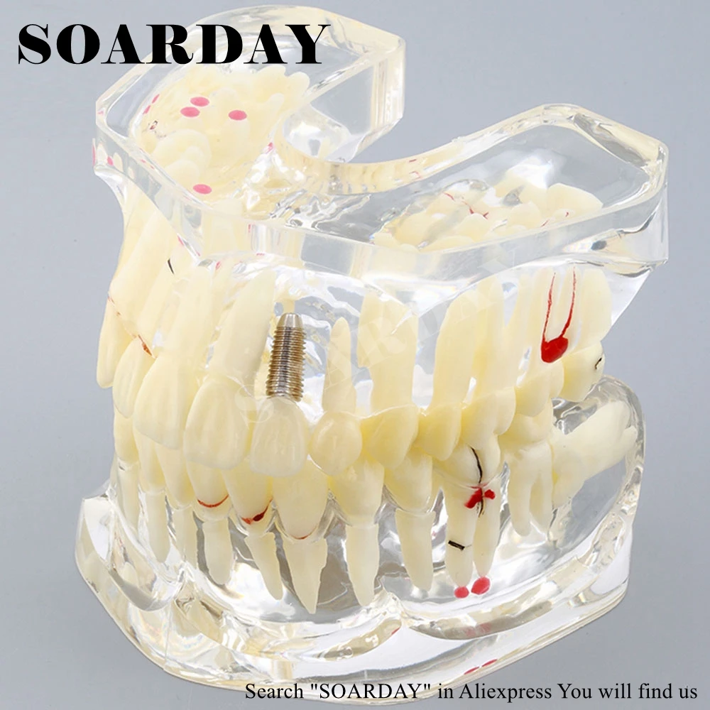 SOARDAY 1 piece 2 times Dental Pathological Model Display deep Caries shallow Caries Teaching Model SOARDAY 1 piece 2 times Dental Pathological Model Display deep Caries shallow Caries Teaching Model
