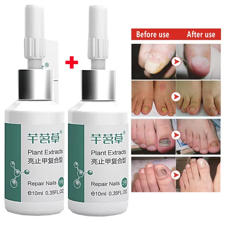 

Fungal Nail Treatment Essence Nail and Foot Whitening Toe Nail Fungus Removal Whitening Onychomyco Feet Care Nail 2pcs
