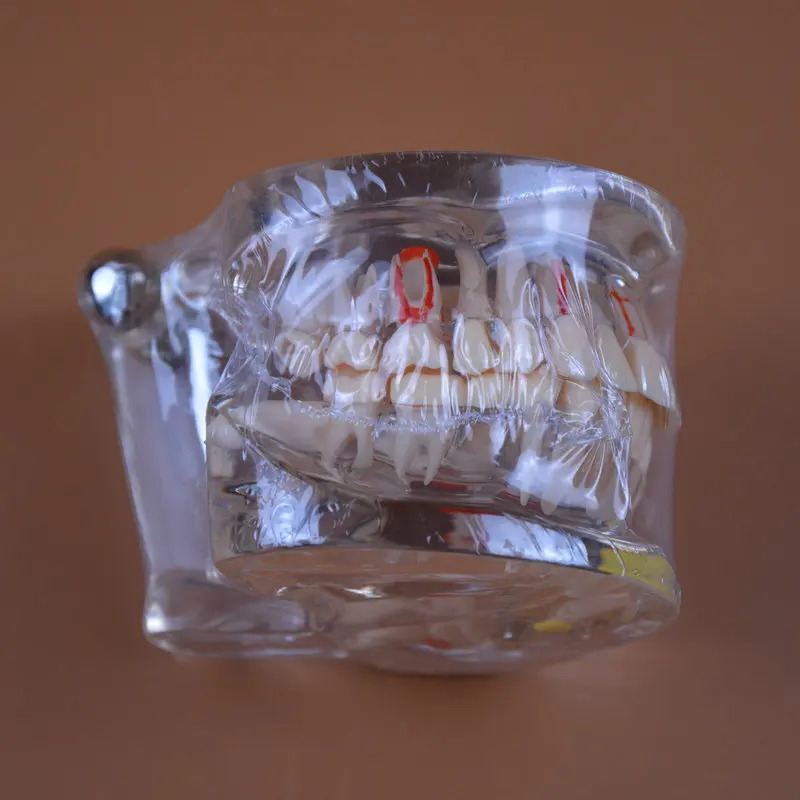 Modelo de Ensino de Odontologia Modelo de Patologia Dental com Implante Modelos de Dentes Modelos de Ensino Lote Odontologia Cuidados Orais Anatomia 2 Pçs - 1 odontologia cuidados orais modelos de dentes anatomia modelos de ensino