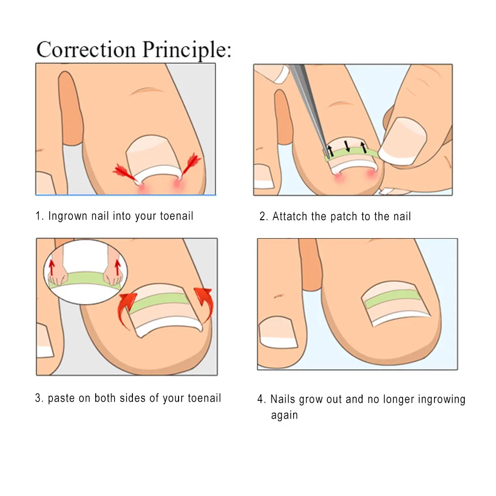 3pcs Ingrown Toenail Pedicure Correction Tools Straightening Clip 3pcs Ingrown Toenail Pedicure Correction Tools Straightening Clip Nail Patch File Glue Treatment Care In Foot Tool From Beauty