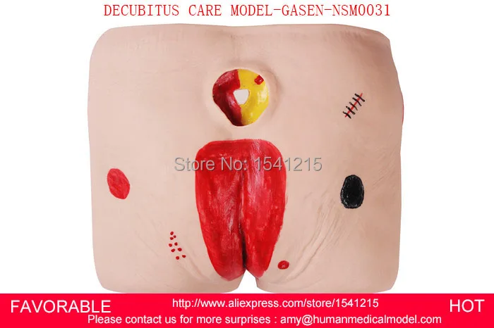 STAGE BEDSORE DECUBITUS ULCER SIMULATOR,DECUBITUS ULCER CARE MODEL, PRESSURE SORE SIMULATOR,,DECUBITUS CARE MODEL-GASEN-NSM0031 peritoneal dialysis simulator model