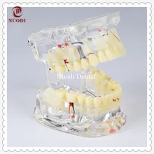 Модель моста зубного имплантата/образовательная модель зубов/со съемным имплантатом crown& abutment/прозрачная для взрослых patological teeth Model