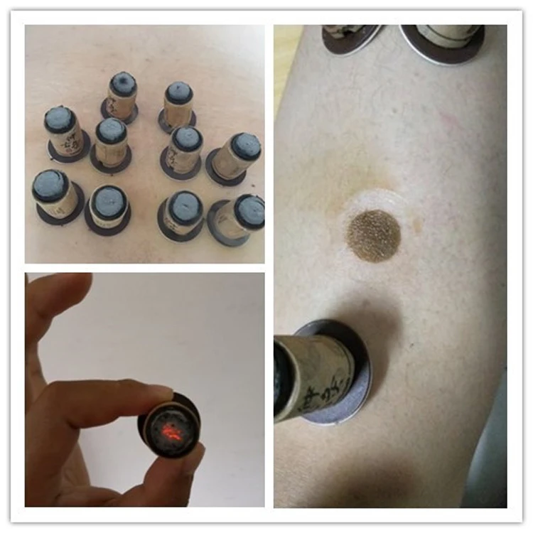 Moxa Moxibustion (27)