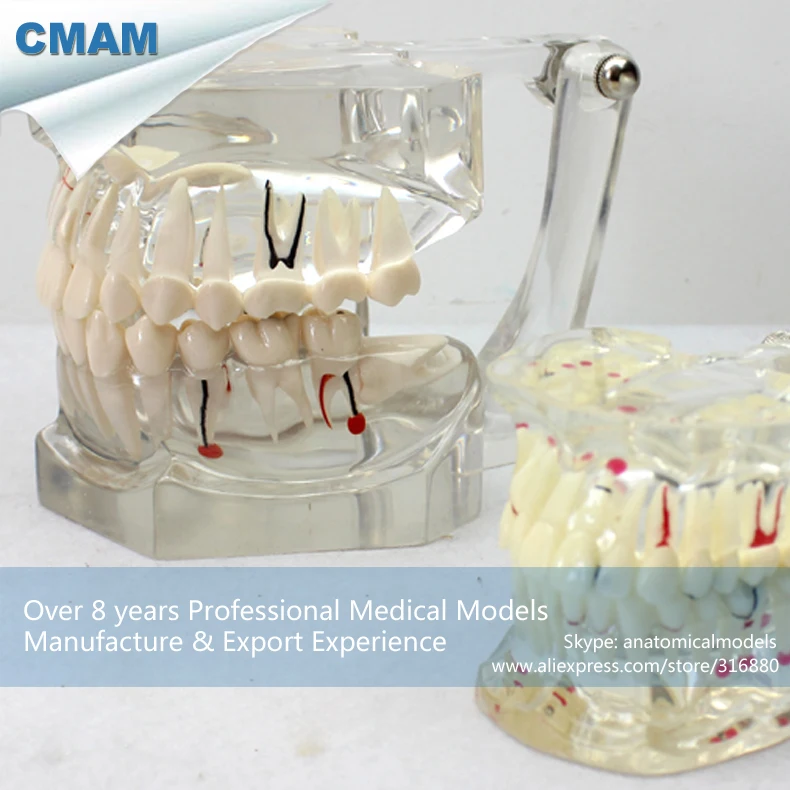 CMAM/12594 Dental-патологическая Стоматологическая модель, 2X в натуральную величину, полости рта человека стоматологический медицинский анатомическая модель