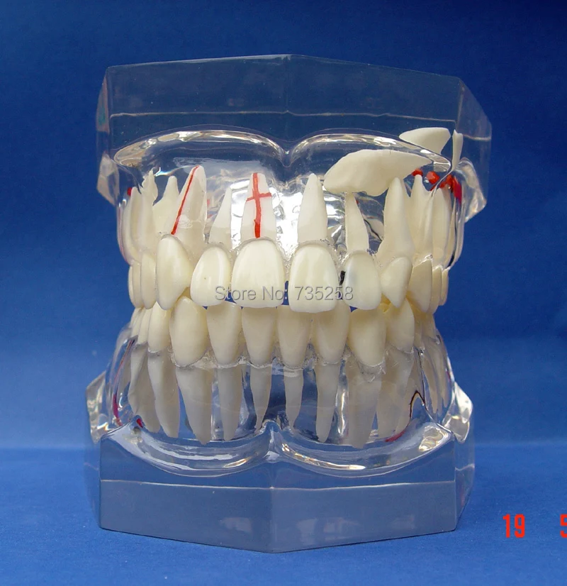 Pathological Model 2 x Magnification Adult teeth,Crystal Material is Qualitative Tooth Pathological Teaching Model цена Pathological Model 2 x Magnification Adult teeth,Crystal Material is Qualitative Tooth Pathological Teaching Model цены онлайн