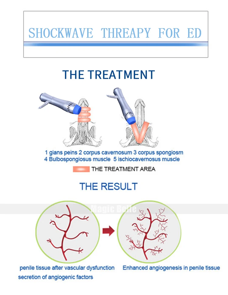 Лучшая физическая шоковая волновая терапия для функциональной боли рельефный питчер shockwave эрекция дисфункция ED