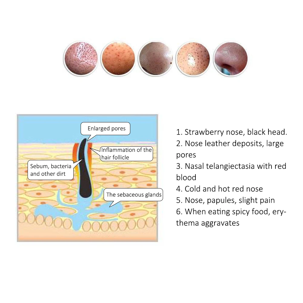 Травяные против носовых клещей, удаляющие розовые угри, крем для удаления угрей с красного носа, лечение акне, сужающие поры, отбеливающая мазь для лица