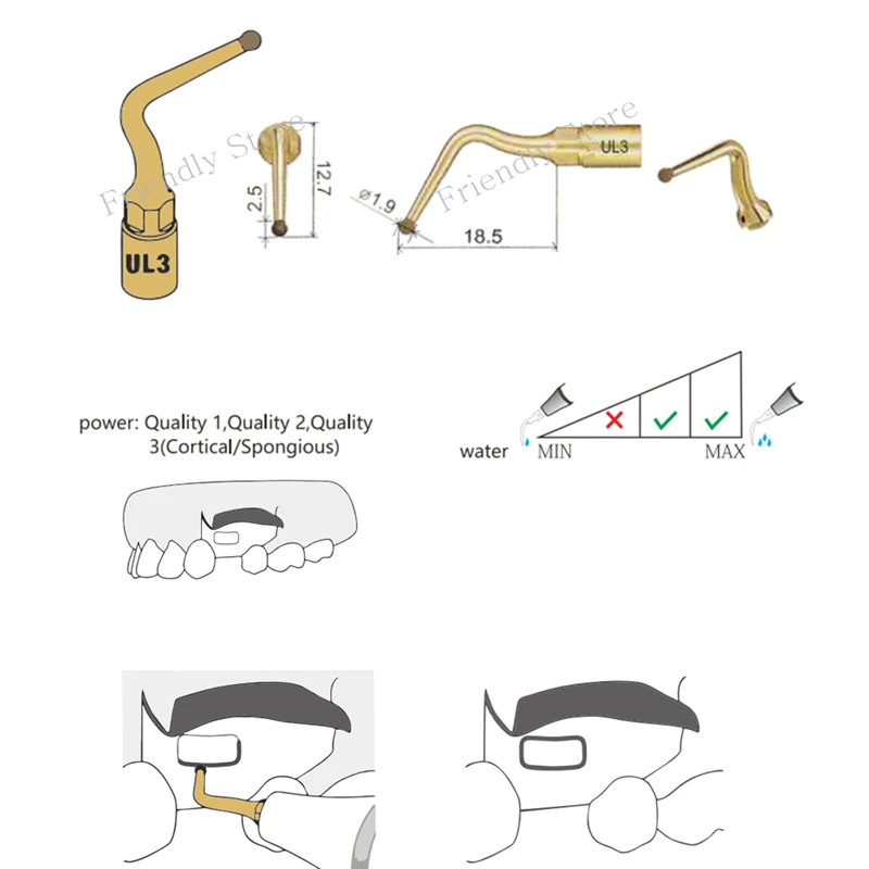 Денты синус подтяжка 3 шт. UL3 Стоматологический материал для мектрона и дятла пьезохирургии оборудование Стоматологические Инструменты для здоровья