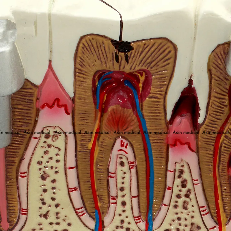 Высокое качество кариес Зуб модель стоматолога пациента связь Анатомия Модель Стоматология Богатые детали обучающие средства оборудования