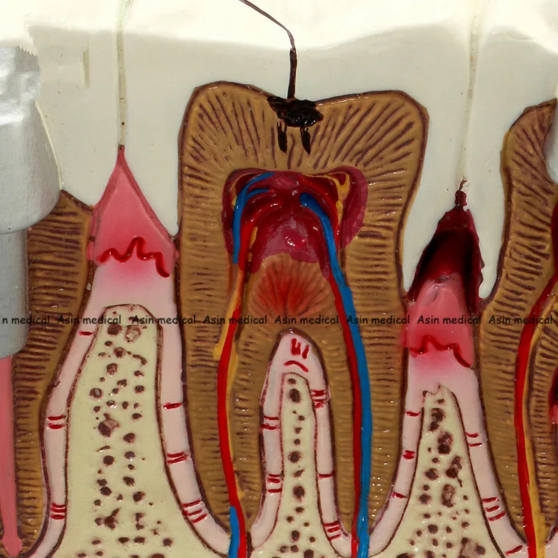 Auxiliares de Ensino Alta Qualidade Cárie Dente Modelo Dentista Paciente Comunicação Anatomia Odontologia Detalhes Ricos Equipamento 9 High Quality Beleza e saúde