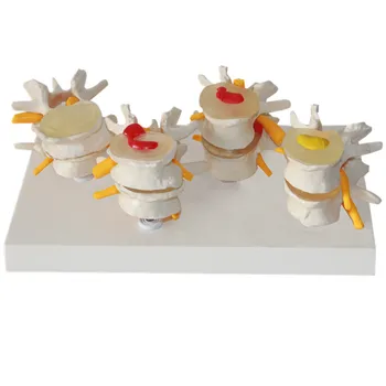 

Lumbar vertebrae lumbar disc herniation model spinal cord human skeleton model