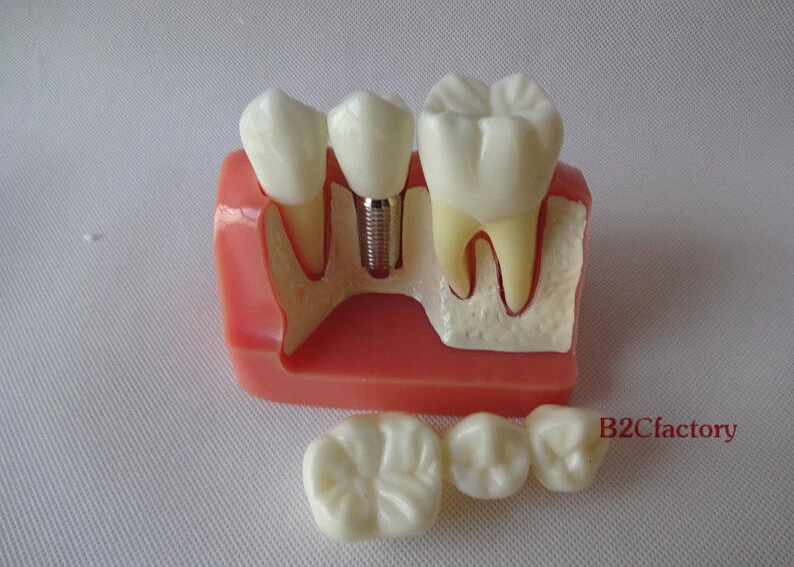 

Dental Implant Analysis Crown Bridge Demonstration Teeth Model 2017