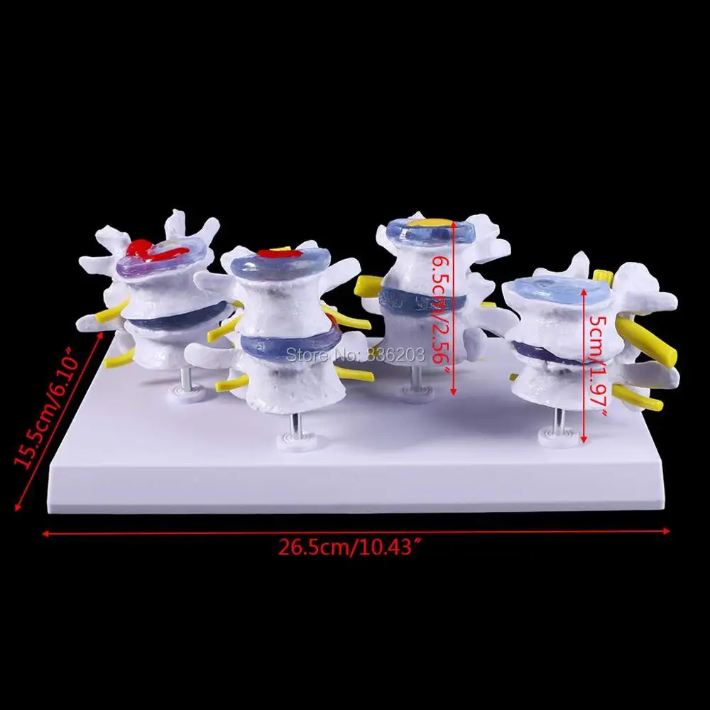 Жизнь Размер 1 Набор человеческая поясница повреждение позвоночника остеопороз модель Делюкс травматический пистолет медицинский Скелет травма Анатомия инструменты