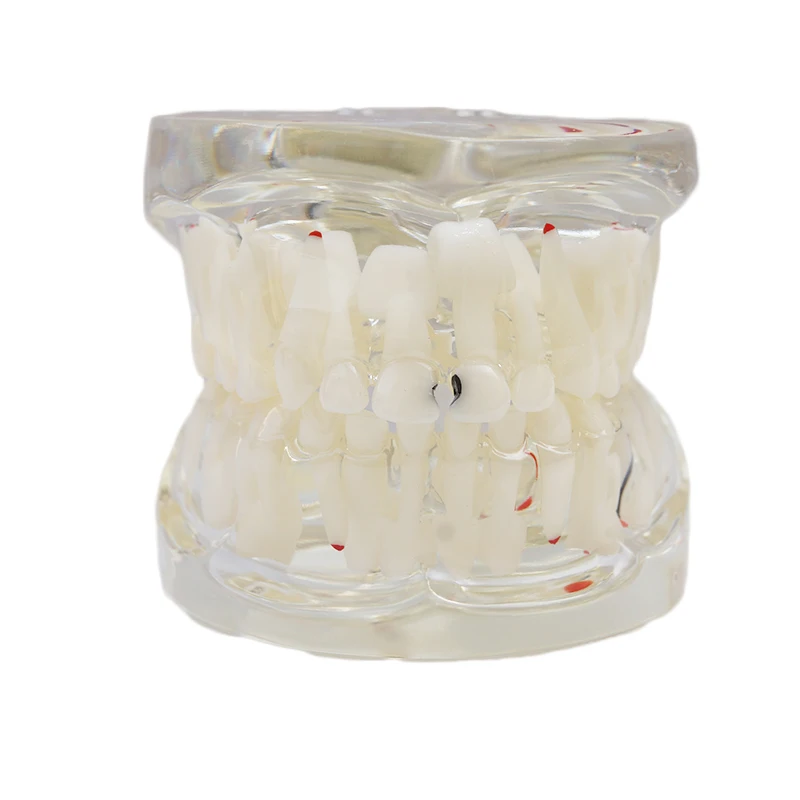 

1PC Dental Oral Clear Mixed Age with Caries Products Dental Educational Study Model