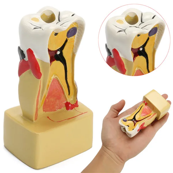 

10x6x4cm Dental Anatomy Education Teeth Model 6 Times Caries Comparative Study Models For Dentist Studying and Researching