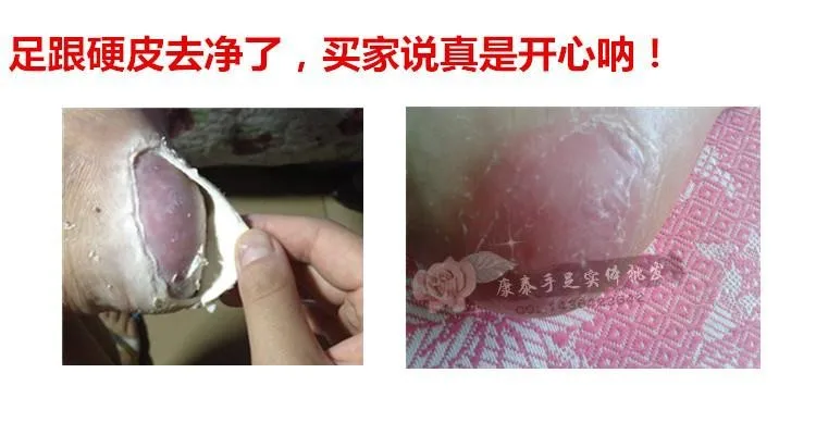 treatment the Dollar removal Natural USD or plantar warts or discount verruga de States finger Chinese United warts bump Stop118 foot Last on for the pomada machine gel 8 treatment the Dollar 8