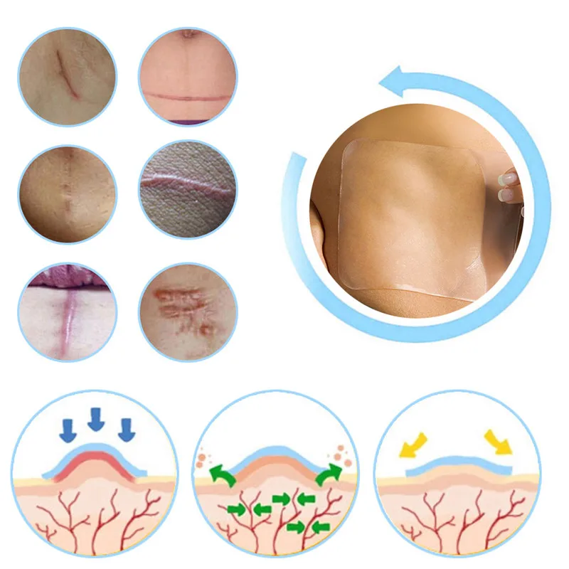 Силиконовый патч для удаления многоразовый гель от угрей шрам терапия силиконовый пластырь удаление травм ожога лист ремонт кожи ожоговый рубец ремонт кожи