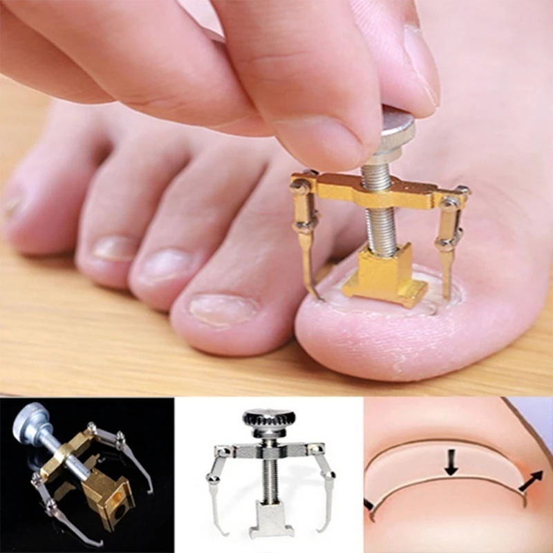 Professional Ingrown Toenail Toe Fixer Recover Correction Device