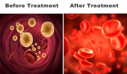 diabético lllt para rinite hipertensão tratamento a