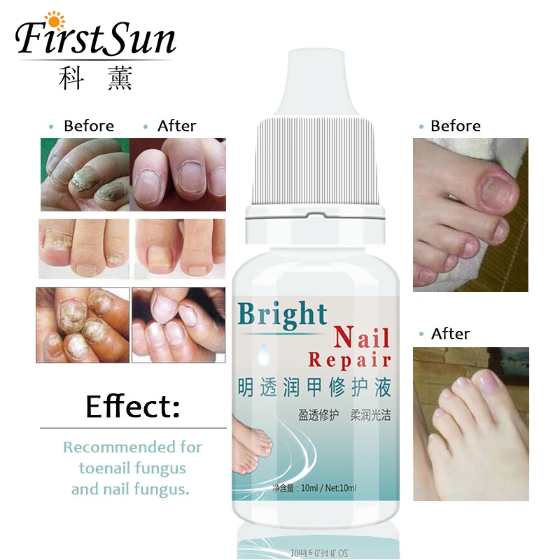 10ml Nail Fungus Treatment Cream Onychomycosis Paronychia Anti Fungal Nail Infection Kills 99.9% Bacteria and Fungus Nail Care