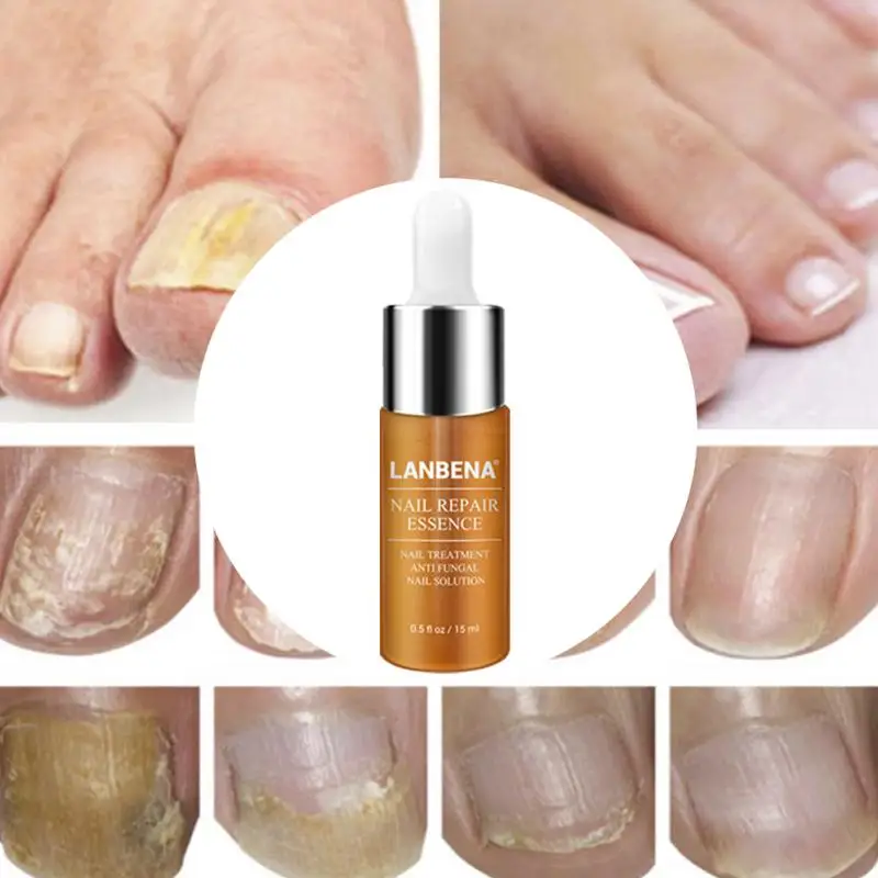 Защита ноги эфирное масло для ухода за кожей сыворотка удаление грибка здоровый ремонт эссенция для ногтей Лечение инструменты для ухода