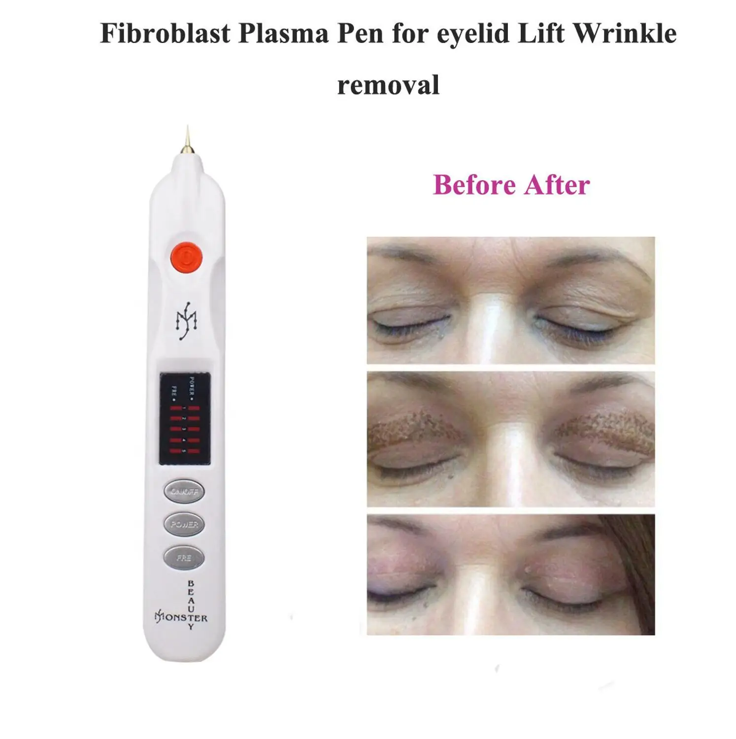 

High Power Fibroblast Plasma Pen for Mole Dark Spot Wart Tattoo Wrinkle Removal Face Eyelid Lift Plasmapen