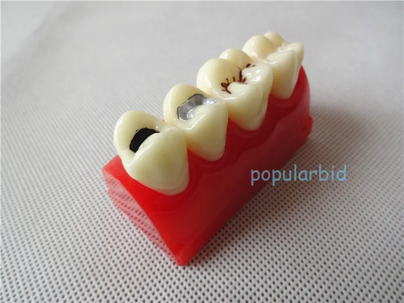 Стоматологическая Яма и трещина уплотнение лечение зубов исследование зубов узнать модель