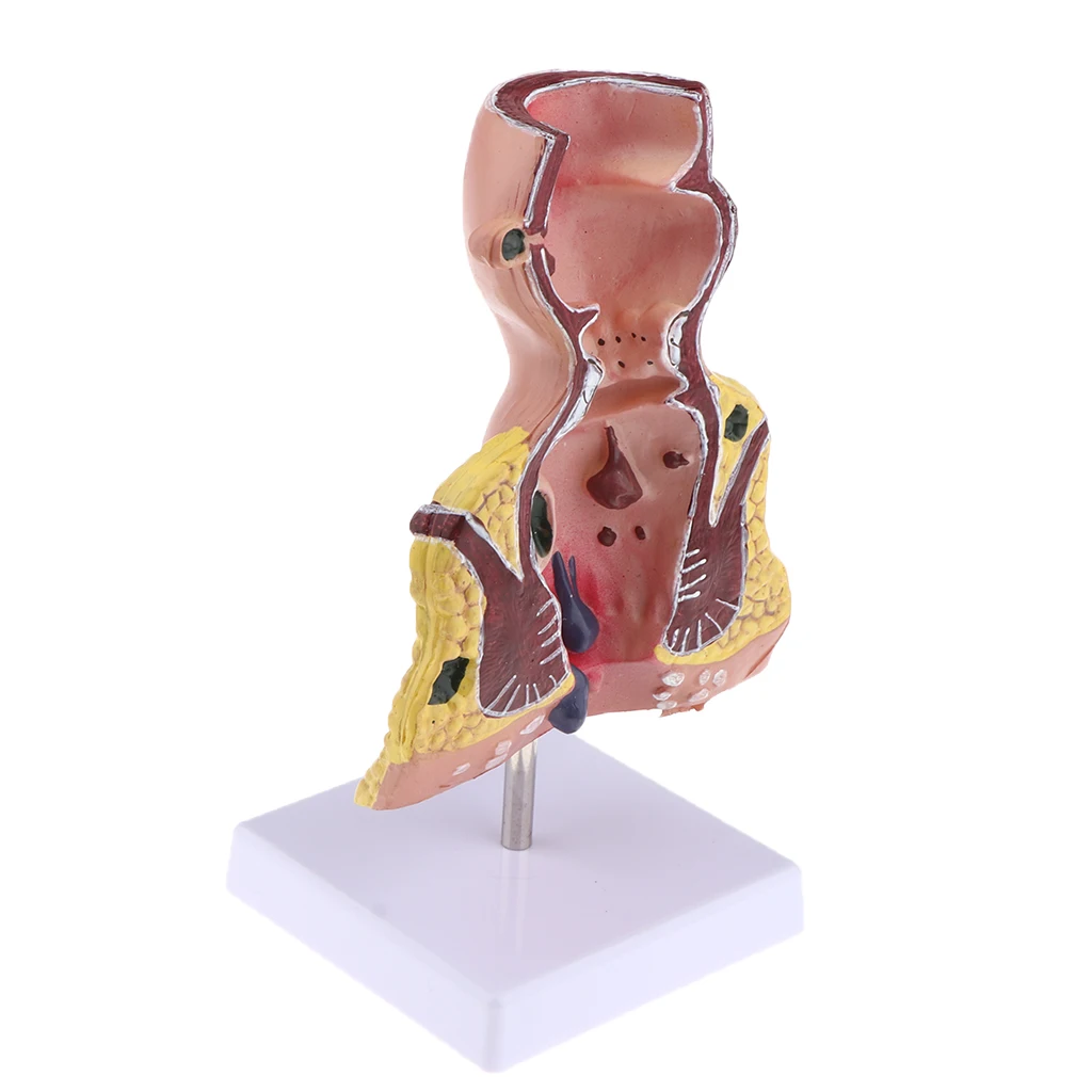 5x Pathological Rectum with Anus Hemorrhoid, Human Anatomical Model Anorectal Diseases Learning for Student Teacher Acss