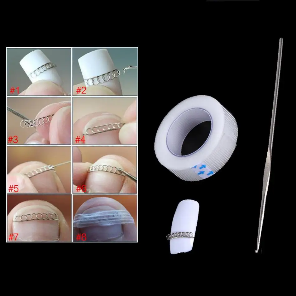 

3Pcs Ingrown Toe Nail Correction Tool Set Wire Fixer Pedicure Recover Paronychia Acronyx Bunion Corrector Foot Care Tool