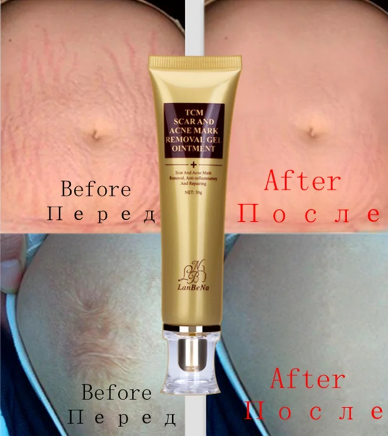 2017 New Style LANBENA Acne Scar Removal Cream Skin Repair Face Cream Acne Treatment Blackhead Whitening Cream Stretch Marks 30m e