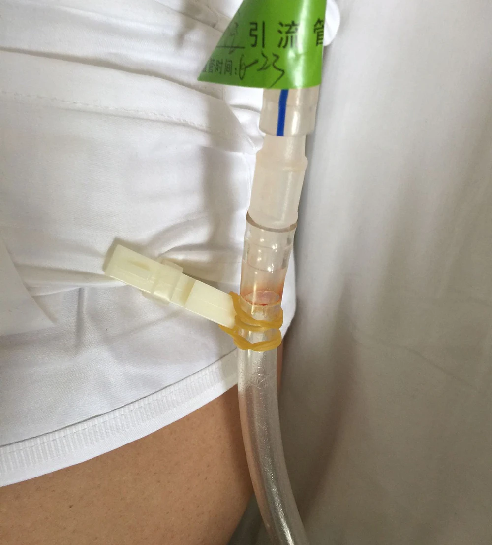 5PC Analgesic Pump Clamp Clinical Catheter Fixation Clamp Medical