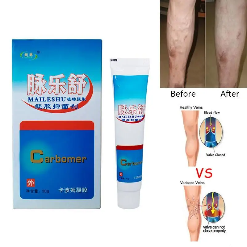 1Pcs Herbal Varicose Veins Cream Remove Oniment Anti Foot Leg Vasculitis Phlebitis Healing Massage U2 | Красота и здоровье