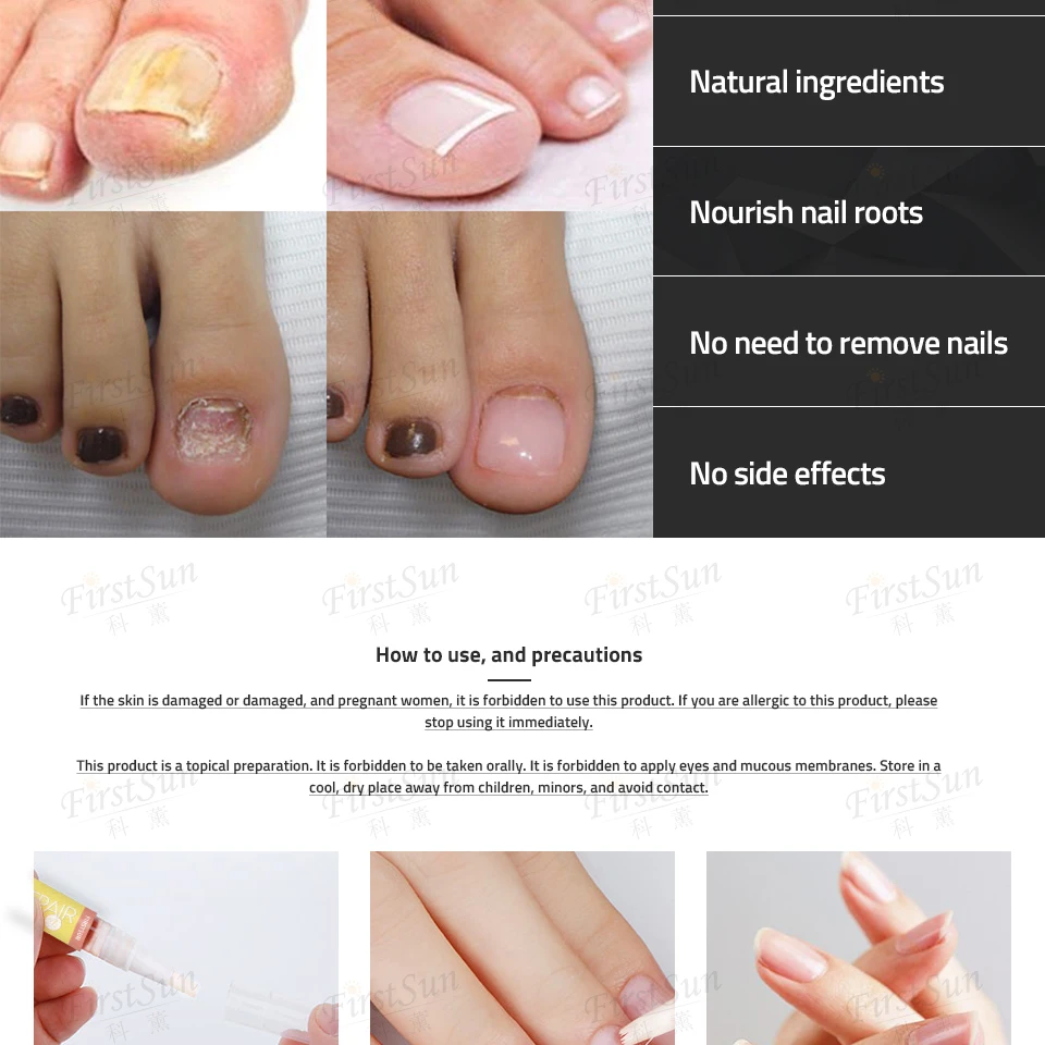 Мощная ручка для лечения Ногтей Onychomycosis Paronychia против грибковой инфекции ногтей, китайский травяной грибок для ног, уход за ногтями, восстанавливающая сыворотка