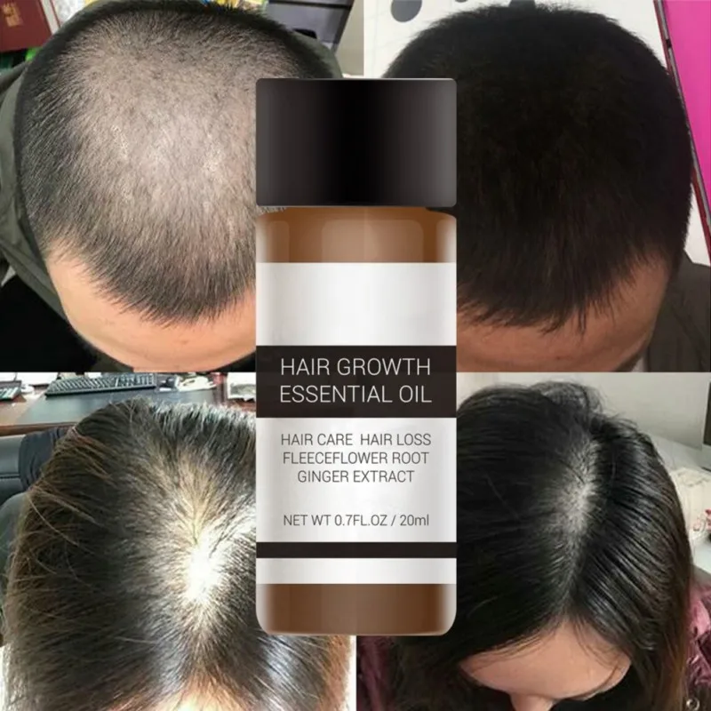 Роста волос суть быстро Мощный товары эфирное масло жидкость лечения предотвращения выпадения волос уход за волосами Andrea 20 мл C3