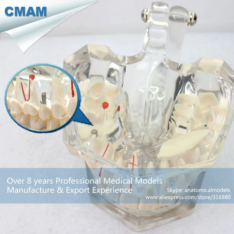 

CMAM/12594 Dental- Pathological dental model, 2X life size,Human Oral Dental Medical Teaching Anatomical Model