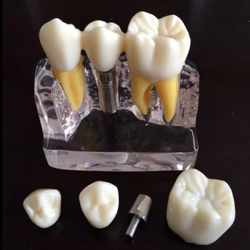 

1set Dental Implant Disease Teeth Model with Restoration Bridge Dentist for Medical Science Teaching