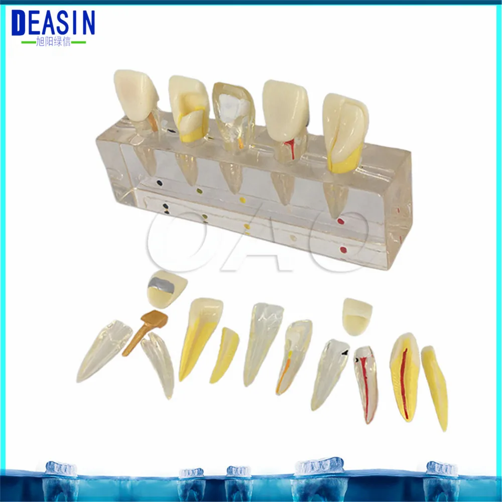 modele-clinique-de-degradation-des-dents-enseignement-et-explication-de-la-pulpe-dentaire-modele-oral-anatomique-amovible