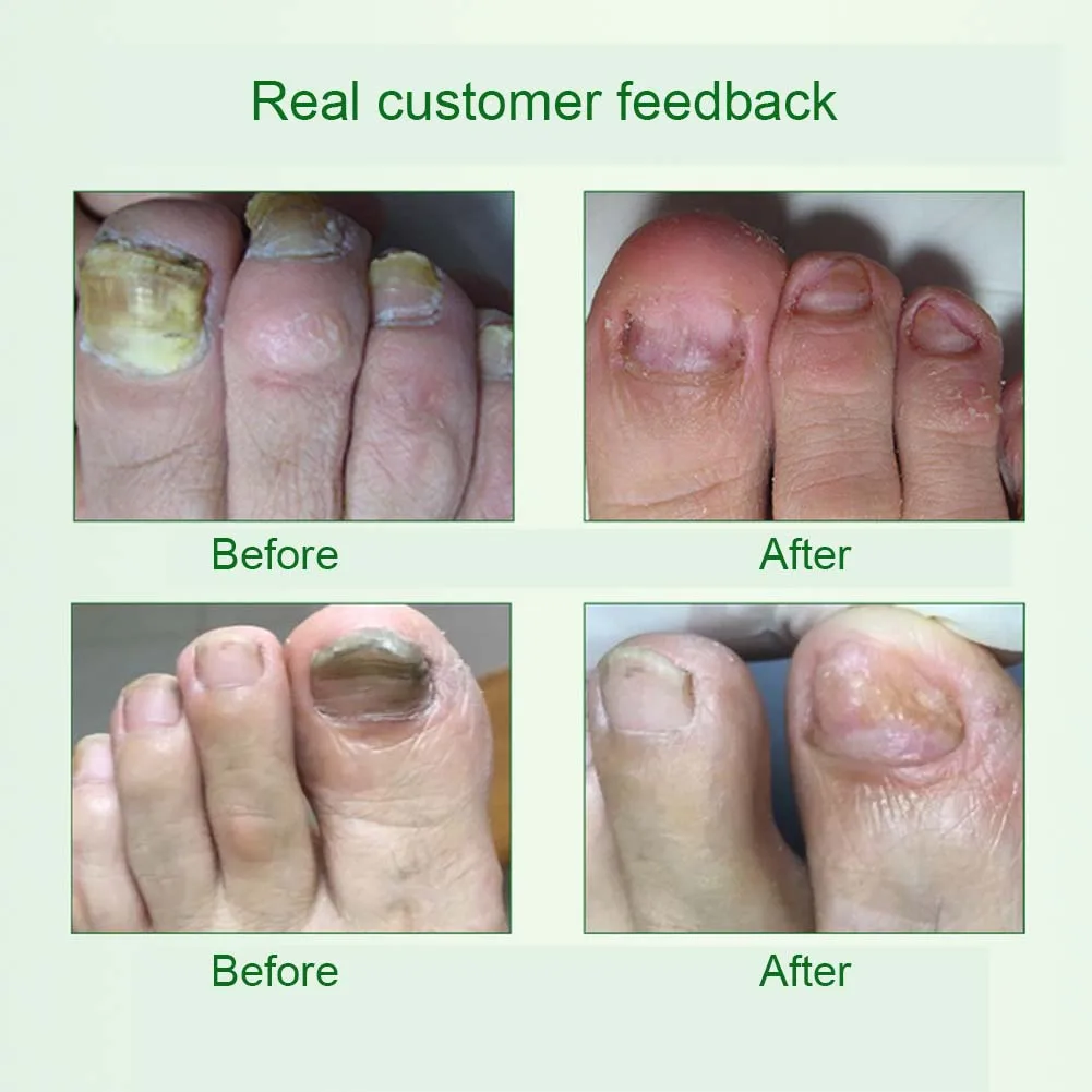 4ml Nail Fungal Treatment Liquid Onychomycosis Removal Anti Fungus Nails Repair Foot Care HS11