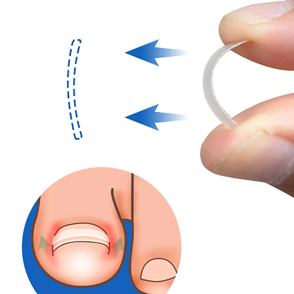 10pcs/bottle Ingrown Toe Nail Correction Sticker Patch Paronychia Correction Elastic Patch Corrector Foot Care Tool Treatment