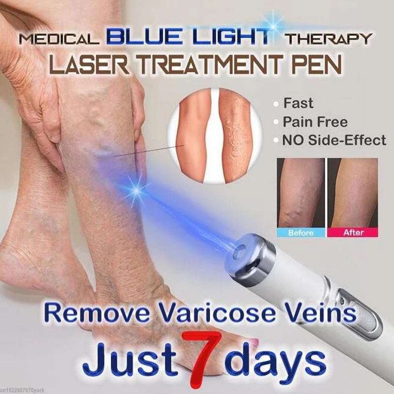 1 шт. медицинский синий светильник лазерная терапия ручка для лечения мягких шрамов устройство для лечения морщин Удаление варикозного расширения вен лазерная ручка