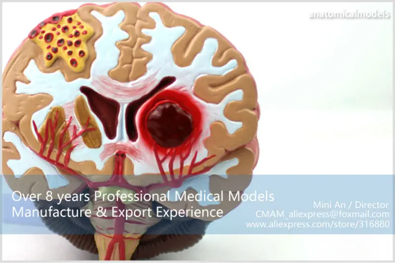 BRAIN10 CMAM model brain diseases anatomical model
