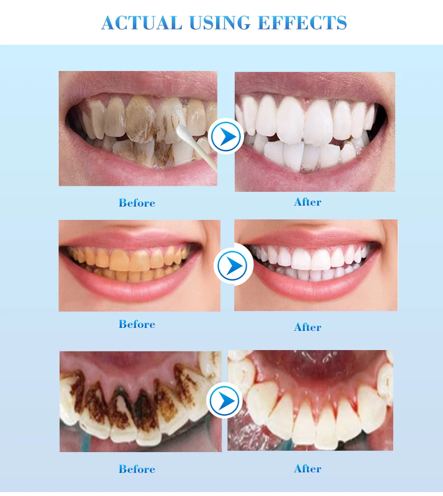 EFERO, 1 шт., белое отбеливание зубов, эссенция, красота, отбеливание, стоматологическая гигиена полости рта, уголь, натуральное отбеливание, уход за зубами, 10 мл