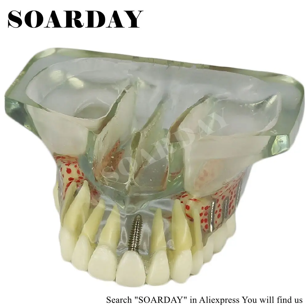 SOARDAY модель зубного имплантата с 6 шт имплантатов ногтей для обучения (съемные)