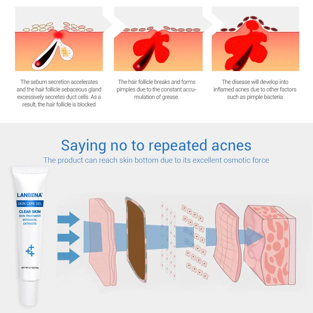 20 г гель для глубокого очищения лица против акне лечение отбеливающий гель увлажнение и сужение пор Бьюти гель для ухода за кожей
