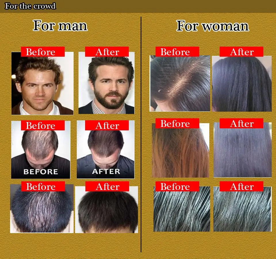 Бренд Okeny, тоник для волос, средство от выпадения волос, быстрый рост волос, продукты для женщин и мужчин, восстановление волос, Yuda Pilatory Treatment