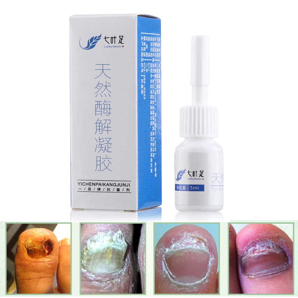 5 ml Nails Care Nail Fungal Treatment Beauty Manicure Anti Fungus Repair Liquid Health Care Bright Nail Repair Tools