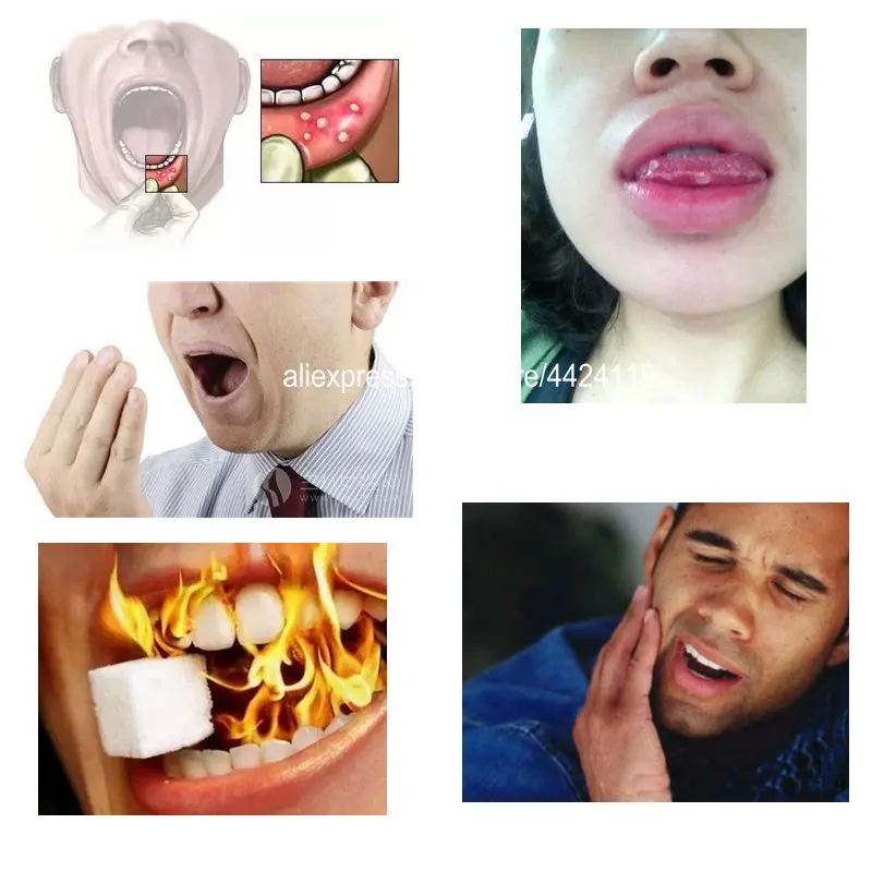 Ремонт внутренней тепловой язва полости рта специальная зубная паста уход за