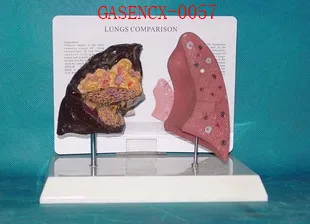 

Comparison of smoking lung and normal lung model - GASENCX-0057